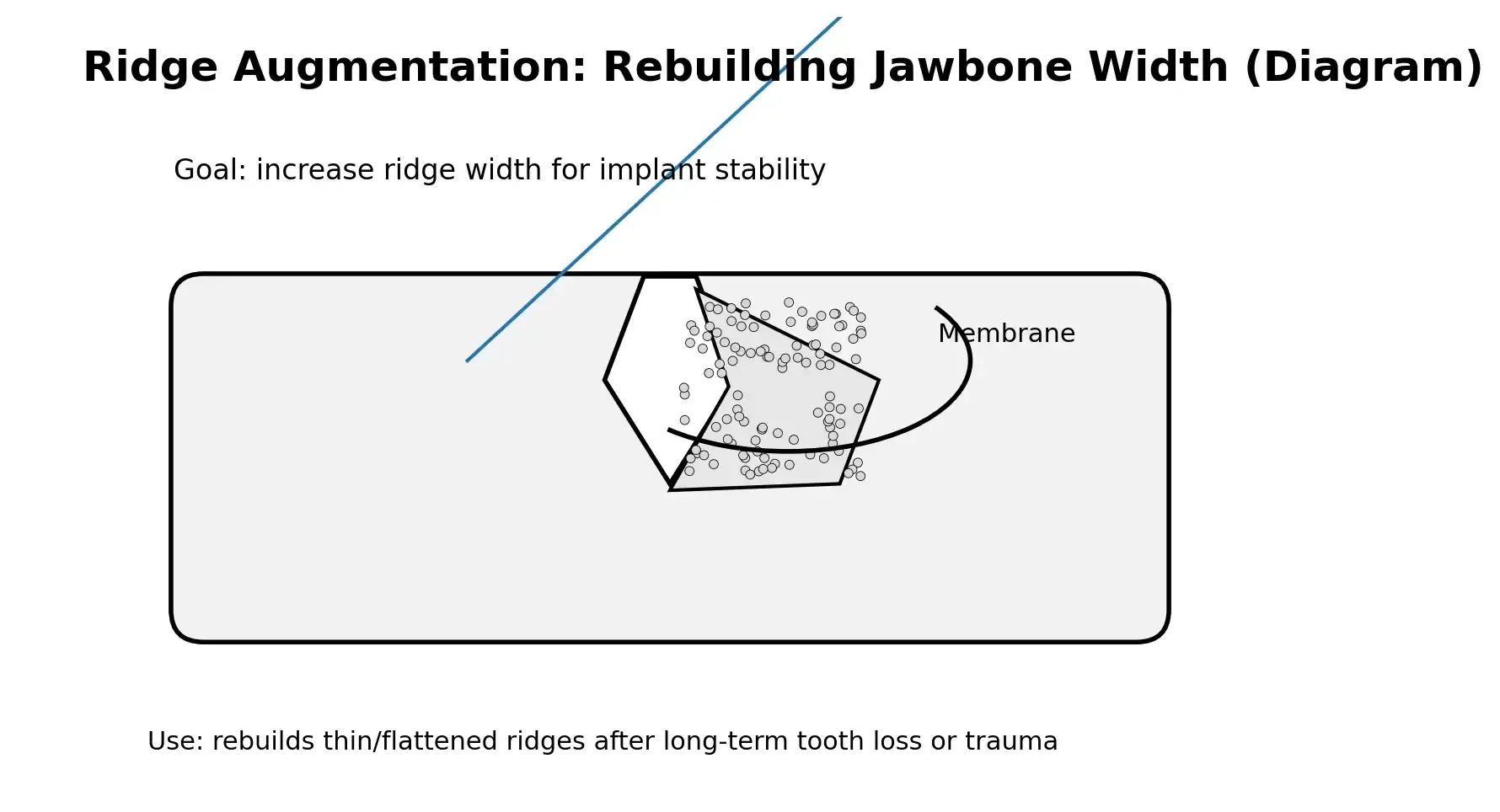 Ridge augmentation bone graft to rebuild jawbone width for dental implants in Greenville, NC