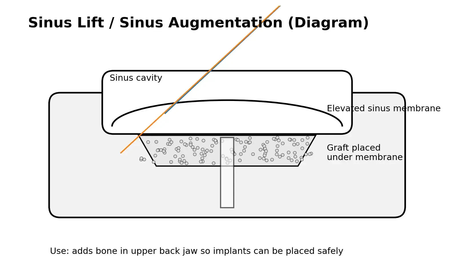 Sinus lift bone graft procedure to support dental implants in Greenville, NC