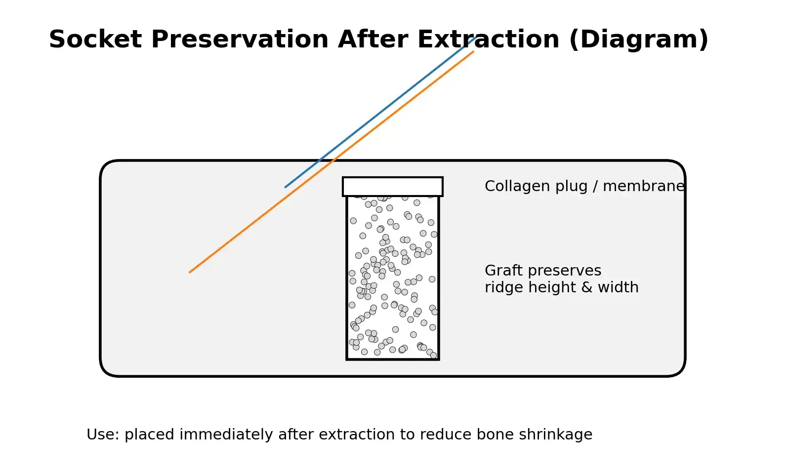 Socket preservation bone graft after tooth extraction in Greenville, NC
